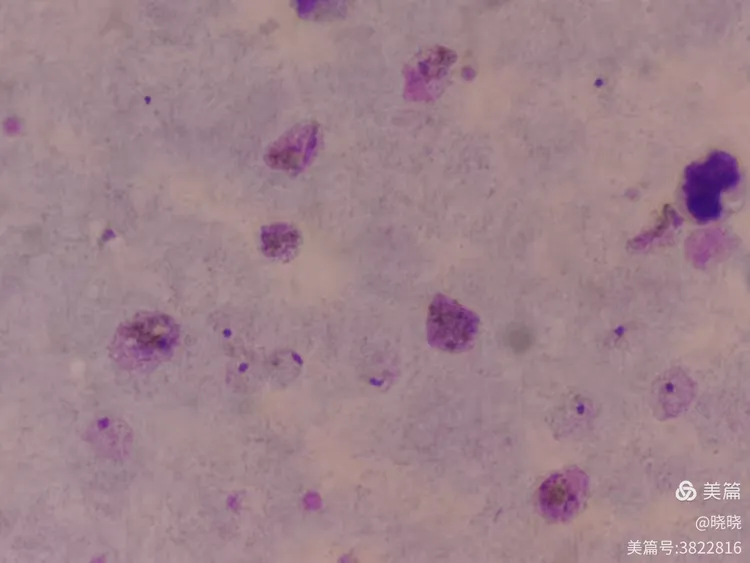 三种疟原虫厚膜染色法对比